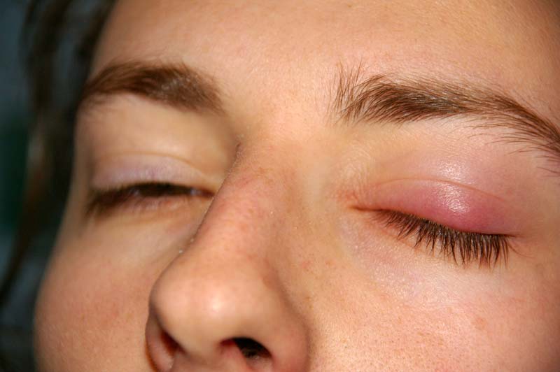 Dr. Yeung Ho Hong(楊浩康) explains Chalazion